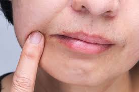 Natural Remedies For Angular Cheilitis Dental News