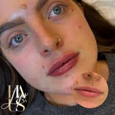 Amount: 0.7ml Filler: EPTQ 300 Anaesthetic: Topical Numbing Cream Time:  30mins Cost: £90 until november DM @hausoflips for more info👄 @ Wakefield