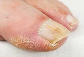 Image result for onychomycosis