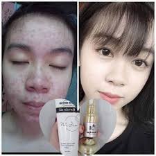 TẶNG QUÀ 50K] Combo kem face chuyên mụn Huỳnh Đỗ, hết mụn thâm, dưỡng trắng  da, ngăn ngừa lão hóa