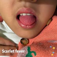 Image result for Scarlet Fever