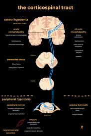 Image result for Floppy Infant