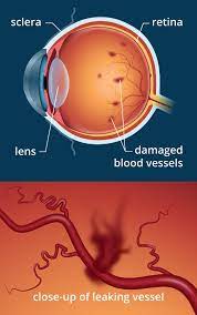 Check spelling or type a new query. Diabetes And Its Effects On Your Eyes Eye Doctor Q A