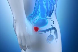 Explains prostate problems including prostatitis and benign prostatic hyperplasia. Teil 4 Der Lvz Klinikserie Prostata Operationen So Gut Sind Sachsens Kliniken Lvz Leipziger Volkszeitung