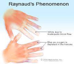 Raynaud S Syndrome Symptoms Treatment Causes Pictures