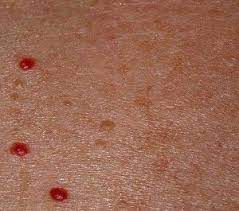 We did not find results for: Manchas Rojas En La Piel Manchas Manchas En La Piel Piel