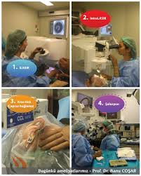 Gozun Seffaf Kornea Tabakasinin Ilerleyici Bir Hastaligi Olan Keratokonus Yuksek Miyop Ve Duzensiz Astigmata Yol Acarak Gormeyi Bozar Neys Serum Bilgi Ikiz