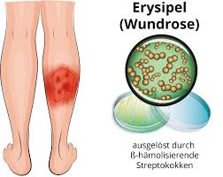 Image result for erysipel photos)