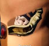 How A Colostomy Bag Works 🤔 | Zack D. Films | Facebook