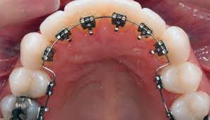 The cost range for braces can vary greatly for each type: Getting Braces In Mexico Playa Del Carmen Prices Timeframes