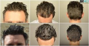 Dr Koray Erdogan 3806 Grafts Fue 2203 Fue 1603 Fue