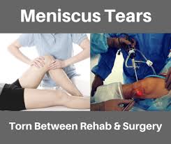 Physical therapy (pt) can be useful for a torn meniscus whether or not you have surgery. The Knee Meniscus Torn Between Rehab Or Surgery Newcastle Sports Medicine