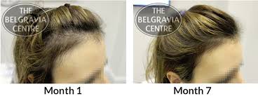 Some studies have shown that about 20 percent of women experience moderate regrowth of hair and about 40 percent experience some regrowth of hair after four months of use; Research Finds Thinning Hair Can Make Women Look 10 Years Older