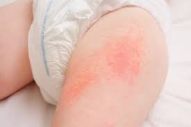 Image result for sweat rash on back baby