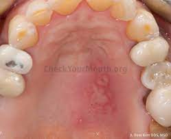 With sores and bumps on palate, you will need to have a dentist check it out as soon as possible, this is because it could be a sign of an underlying medical condition. Introduction Check Your Mouth 2017