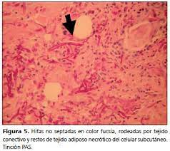Granulomatous gastritis chronic granulomatous inflammation may be caused by a variety of systemic diseases, including tuberculosis, syphilis, fungi, sarcoidosis, or crohn's disease. Mucormicosis Cutanea En Un Paciente Inmunocomprometido