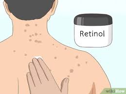 Check spelling or type a new query. 3 Ways To Get Rid Of Back Acne Scars Wikihow