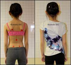 This area, known as the thoracic vertebrae, may develop on its own. Thoracolumbar Scoliosis Scoliosis Of The Mid Spine
