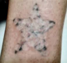 Of course, the size and location of the tattoo will determine if this is possible, but for those tattoos that dr. Top 5 Tattoo Removal Options Alternatives Medermis Laser Clinic
