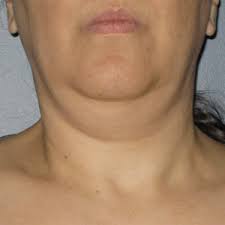 Fda Approved Treatment For Turkey Neck Chevy Chase Md