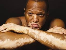 The Man In The Music: Vitiligo: doença e preconceito