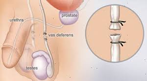 Vasectomia Vantaggi Rischi Costi E Reversibilita