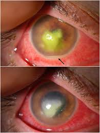 Drugs used to treat corneal ulcer the following list of medications are in some way related to, or used in the treatment of this condition. Corneal Ulcer Eye Disorders Merck Manuals Professional Edition