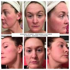 On this #transformationtuesday, I want to tell you about my friend. She's a  hard-working mom who lives in Kentucky. Once upon a time she started using  Rodan + Fields skincare as a