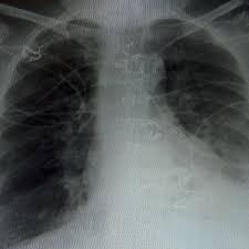 Chronic obstructive pulmonary disease (copd). Copd Chronisch Obstruktive Bronchitis Die Unbekannte Volkskrankheit Wissen