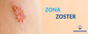 Aceasta afectiune cutanata este caracterizata de prezenta unei eruptii localizate, care apare de cele mai multe ori la nivelul fetei, pieptului si abdomenului. Zona Zoster Simptome Manifestari Tratament