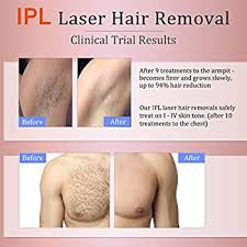 Shaving around your bikini or butts is tricky work and often results in agonising side effects like cuts, bumps, and ingrown hairs. Ipl Laser Hair Removal For Women Men Mismon Permanent Hair Removal Device For Bikini Line Arms Armpit Legs Etc With Skin Color Sensor And Glasses More Safe And Effective Ipl