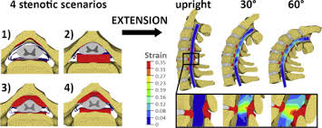 Due to its location in the spine. Numerical Investigation Of The Relative Effect Of Disc Bulging And Ligamentum Flavum Hypertrophy On The Mechanism Of Central Cord Syndrome Sciencedirect