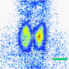 Kalte knoten sind bereiche in der schilddrüse, die eine reduzierte aktivität aufweisen. Schilddrusensprechstunde Thermoablation