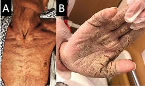 Image result for scabies norvegica