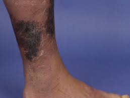 Necrotising fasciitis is a severe bacterial soft tissue infection marked by edema and necrosis of subcutaneous tissues with involvement of adjacent fascia and by painful red swollen skin over. Necrotising Fasciitis Dermnet Nz