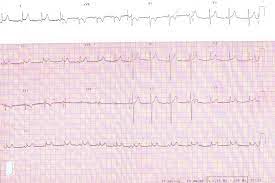 In such cases of cardiac tamponade, ekg or holter monitor will then depict electrical alternans indicating wobbling of the heart in the fluid filled pericardium, and the capillary refill might decrease. Diagnosis Of Acute Pericarditis