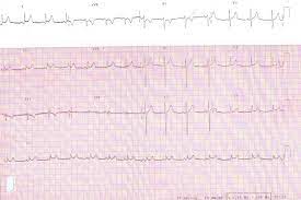 In such cases of cardiac tamponade, ekg or holter monitor will then depict electrical alternans indicating wobbling of the heart in the fluid filled pericardium, and the capillary refill might decrease. Diagnosis Of Acute Pericarditis