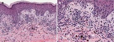 Image result for Fixed Drug Eruption