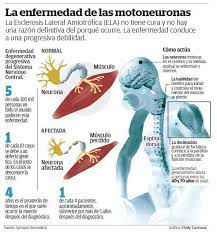 Pero, ¿qué es la ela? Que Es La Esclerosis Lateral Amiotrofica Ela Que Sabemos Sobre Esta Enfermedad Puentes Digitales