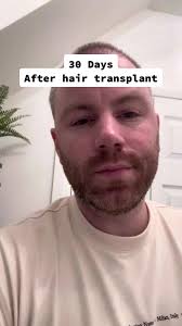 My 30 day update after my hair transplant #turkey #hairtransplant #lon...