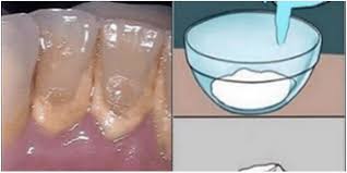 Ce Bain De Bouche Fait Maison Enleve La Plaque Dentaire En 2 Minutes Plaque Dentaire Bain De Bouche Maison Dentaire
