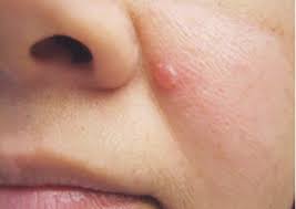 Basalzellkarzinom The Skin Cancer Foundation