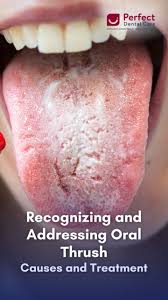 Image result for Oral thrush roof of mouth