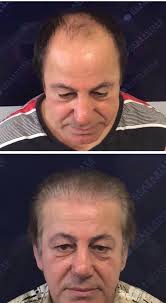 Guaranteed Hair Transplant GHT