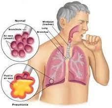 Memberi tugas berupa artikel yang berkaitan dengan gangguan pada sistem respirasi i. Gangguan Pernapasan Pengertian Saluran Dinding Udara Gejala