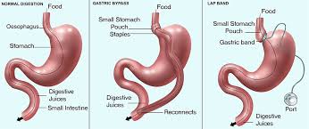 Since you're considering surgery, you likely have many questions about the procedures, their pros and cons, possible complications, and the effect of a bariatric surgery on your everyday life. Guide To Bariatric Surgery Healthdirect