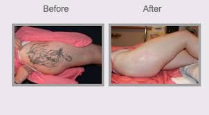 Tattoo removal is considered a cosmetic service under medicaid, the same as it is under medicare. Laser Tattoo Removal Parsippany Troy Hills Weinstein Plastic Surgery