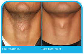 Cost of beard line laser hair removal: Facial Hair Removal For Men Www Macj Com Br