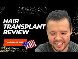 Confident Hair Transplant in Dominican Republic