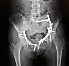What is the collateral circulation after hypogastric artery ligation? Thought You Guys Might Like To See My Pelvis X Ray Xrays